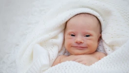 Novorođenče s Downovim sindromom