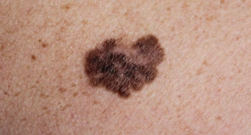 Ilustracija, melanom, maligni tumor na koži