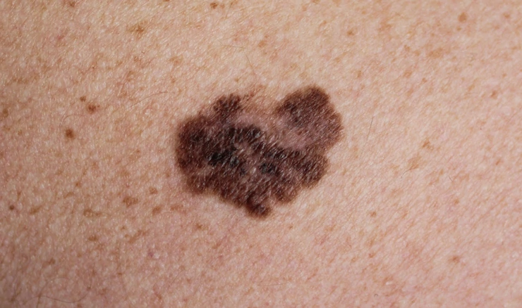 Ilustracija, melanom, maligni tumor na koži