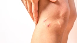 Stari ožiljak može biti uzrok bolova u drugom dijelu tijela